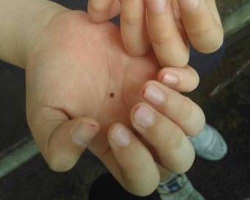 小學生被剪至十指流血。網上圖片