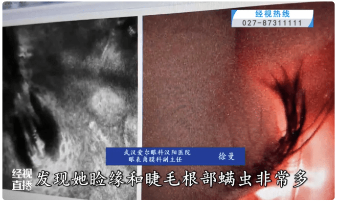 醫生檢驗了她的睫毛樣本，８根睫毛竟藏匿了將近20條活生生的蟎蟲。（截圖自《經視直播》）