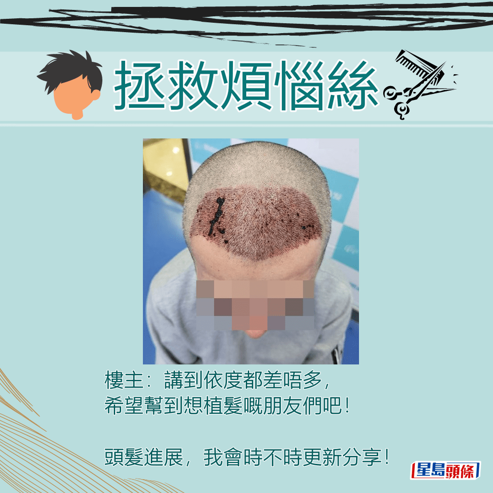 樓主：講到依度都差唔多，希望幫到想植髮嘅朋友們吧！  ​「香港討論區」截圖