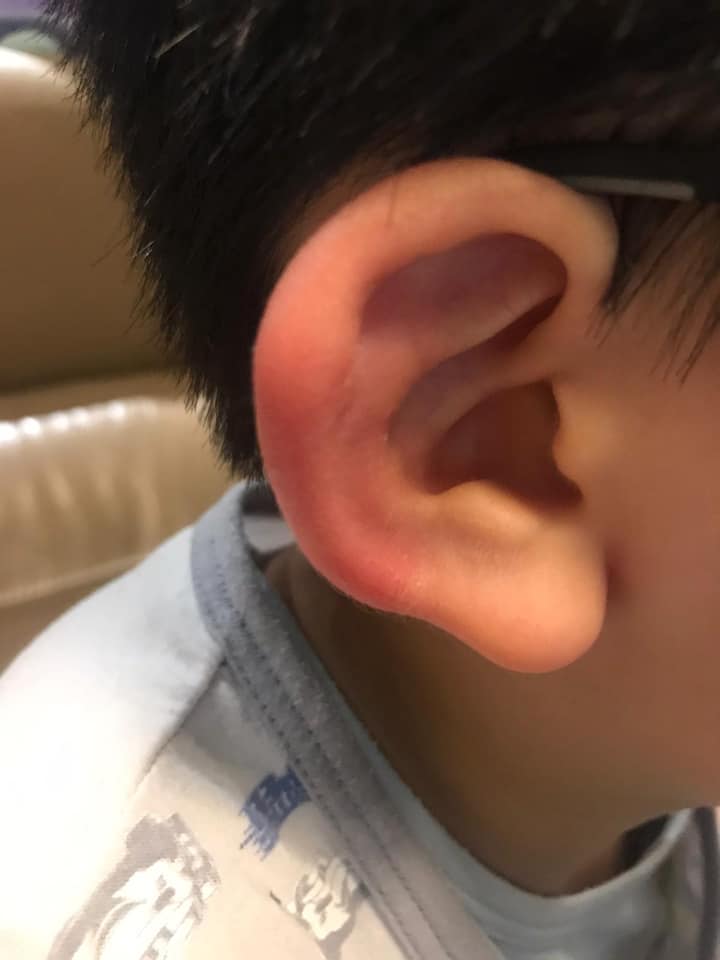 小朋友被咬手腳耳朵紅腫。屯門好生活FB圖
