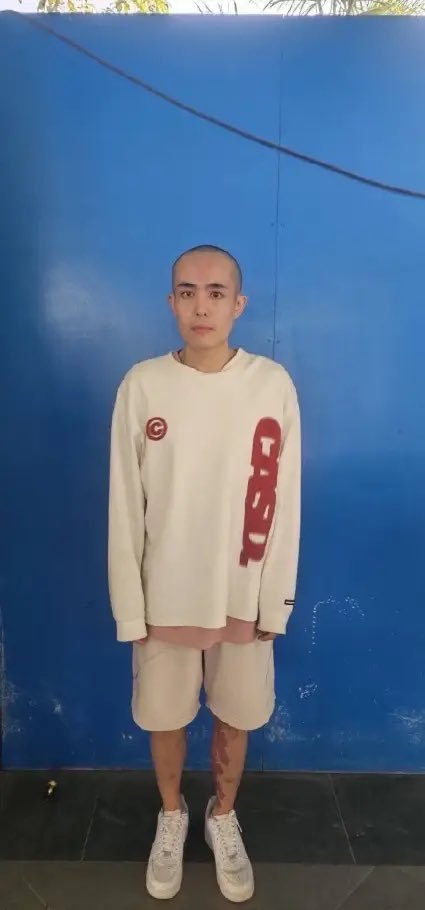 王星终被寻获,遭剃光头照片曝光。王星左边小腿现不明红斑。有网民指出这些红斑是其胎记,但亦有人表示那是伤痕。 王星终被寻获,遭剃光头照片曝光。王星左边小腿现不明红斑。有网民指出这些红斑是其胎记,但亦有人表示那是伤痕。
