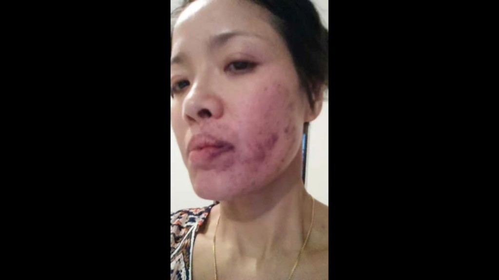 寶珮如提供昔日相片，展示拍戲被真打的傷勢，確是紅腫瘀黑一片。
