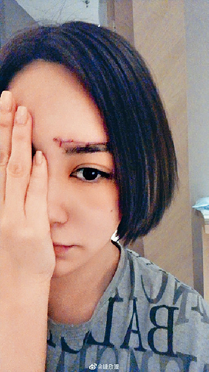 ■阿娇上年9月拆线后疤痕明显。