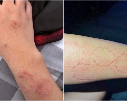 男子手臂被咬出牙齒印。網圖