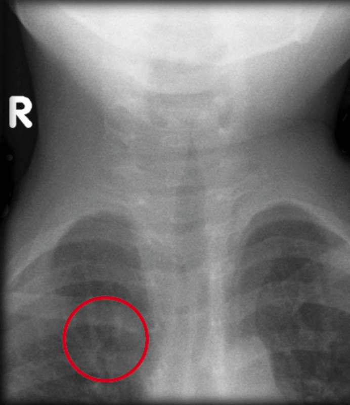●X光影像反映患者的氣管呈尖塔徵狀（Steeple Sign）。