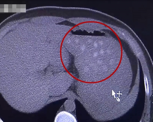 男生胃裏有接近40顆「小白點」。片段截圖