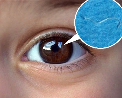 医生在小童眼球取出1.5厘米寄生虫(小图)。示意图片