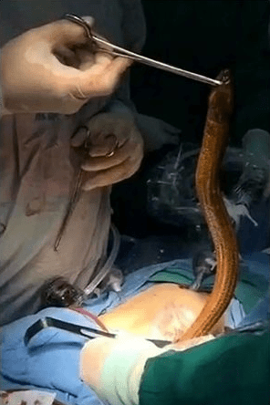 波兰医护人员近日在Facebook分享的图片显示，一条鳗鱼正通过手术从一名男子的腹部取出。FB图