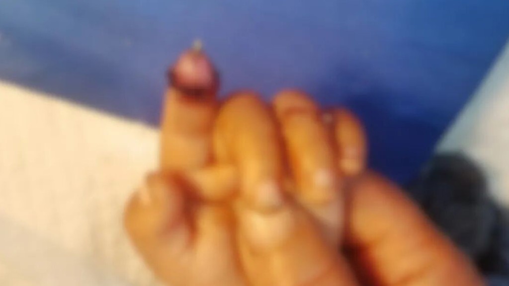 樂樂被兔子咬斷手指。《農民日報》