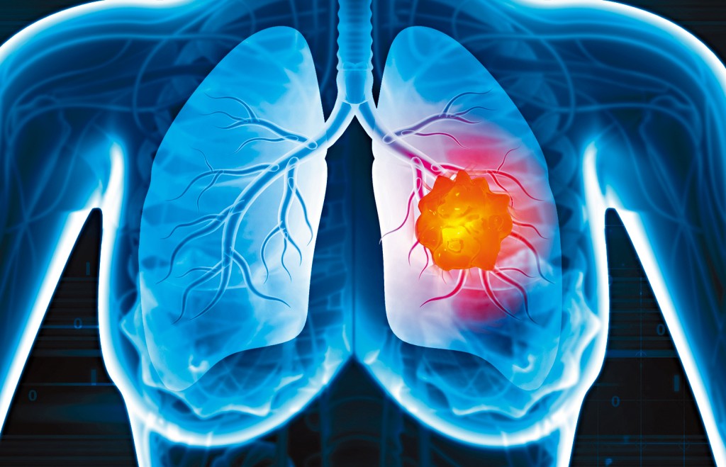 肺結節多在體檢時偶然發現。
