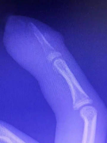 X光片发现少年指骨也出现严重感染。网图