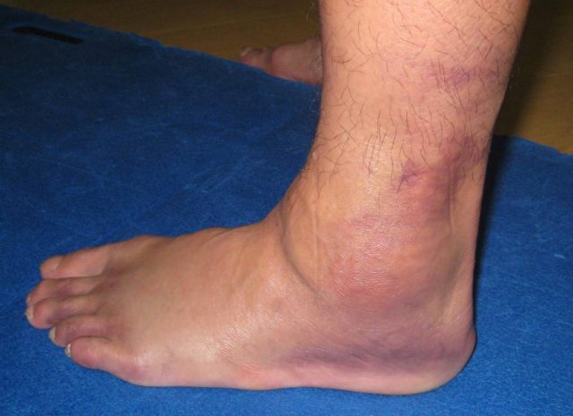 拗柴易致肌腱脫位手尾長。網上圖片