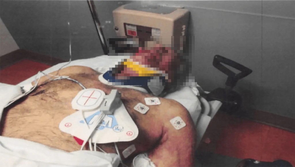 爱泼斯坦颈上留下颇深的勒痕。 美国司法部 爱泼斯坦颈上留下颇深的勒痕。 美国司法部