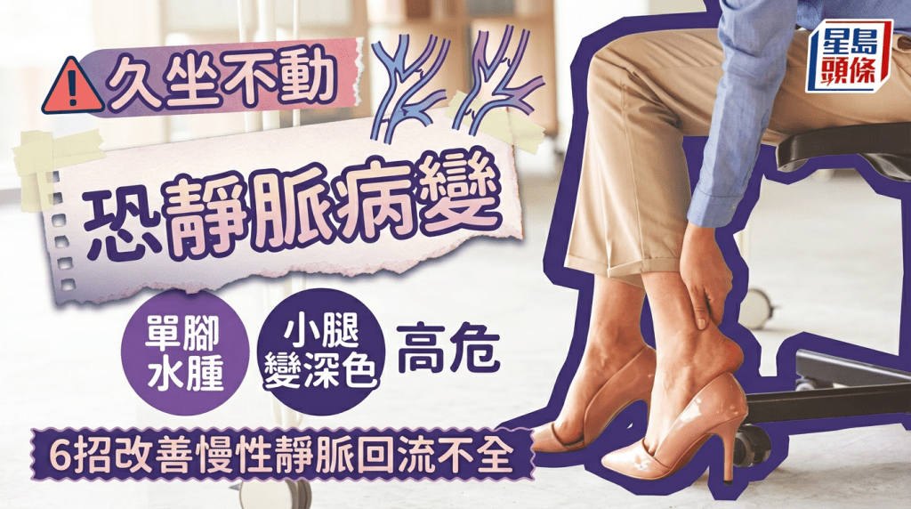 久坐不动恐静脉病变 单脚水肿小腿变深色高危 医生教6招改善慢性静脉回流不全