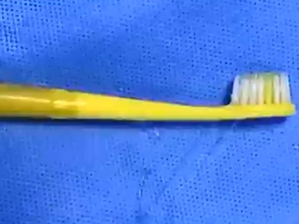 醫生以胃鏡手術將牙刷取出。影片截圖