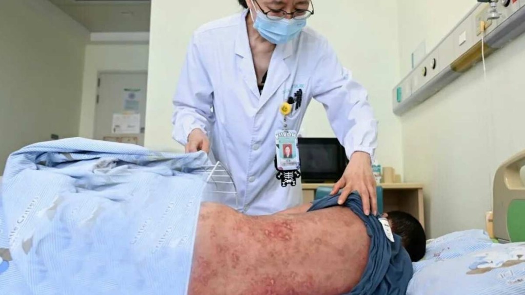 小辉因罕见的毒性表皮坏死溶解症，全身八成皮肤剥落。极目新闻