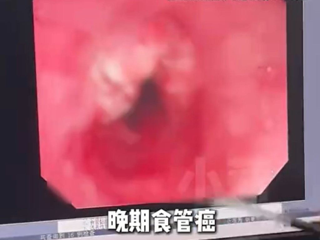 河南有醫院在一個上午，確診11名晚期食道癌患者。小莉幫忙