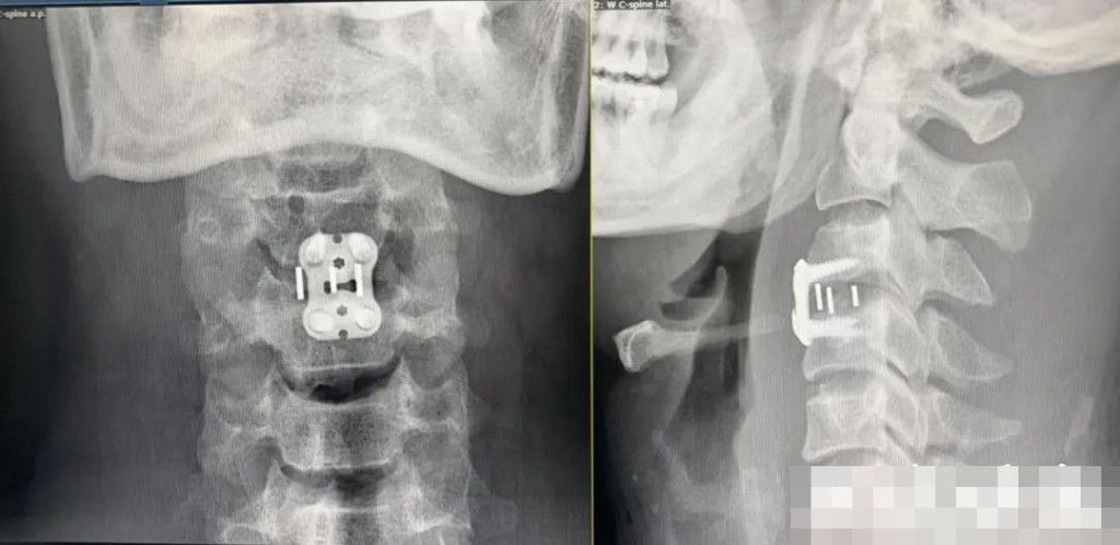 暴力正骨導致頸3-4椎間盤急性突出脫出。《現代快報》