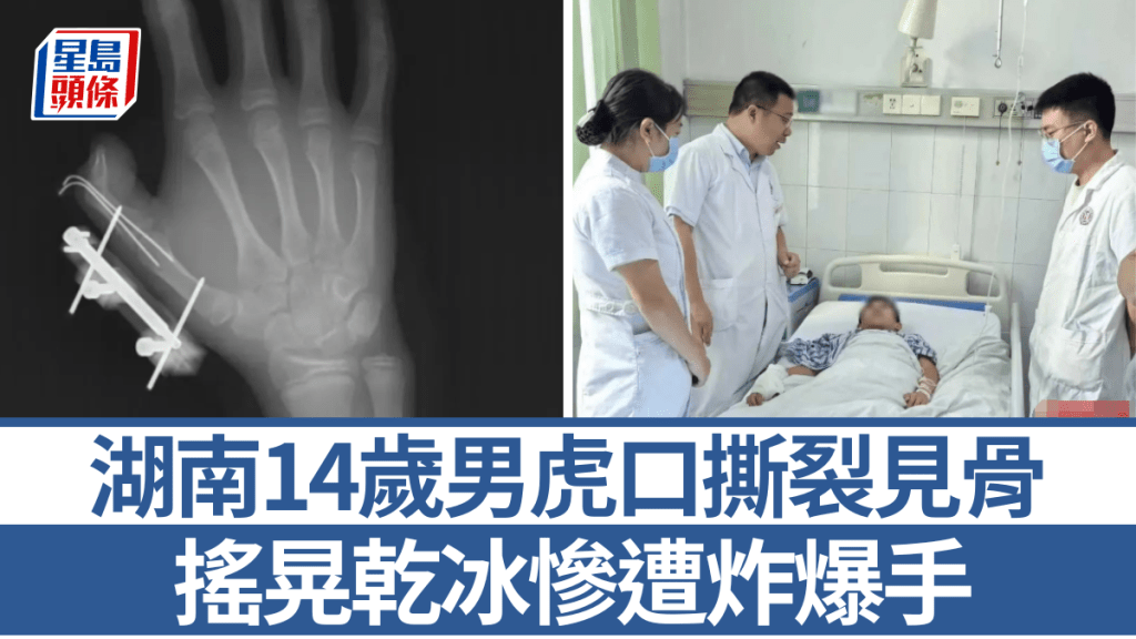 湖南14歲男搖晃乾冰慘遭炸爆手 虎口撕裂10cm直見白骨
