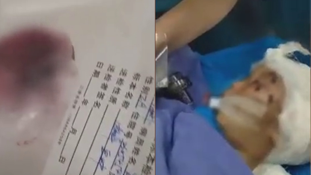 雲南2歲男童被外婆舉起重摔命危，只因打碎杯子。