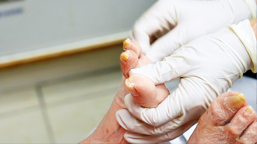 江医生细心为婆婆剪走厚重发黄的脚甲。