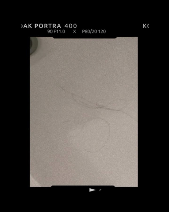 蔣雅文在IG上載影片，可見她的洗頭後，浴缸留下不少頭髮，脫髮問題非常嚴重。