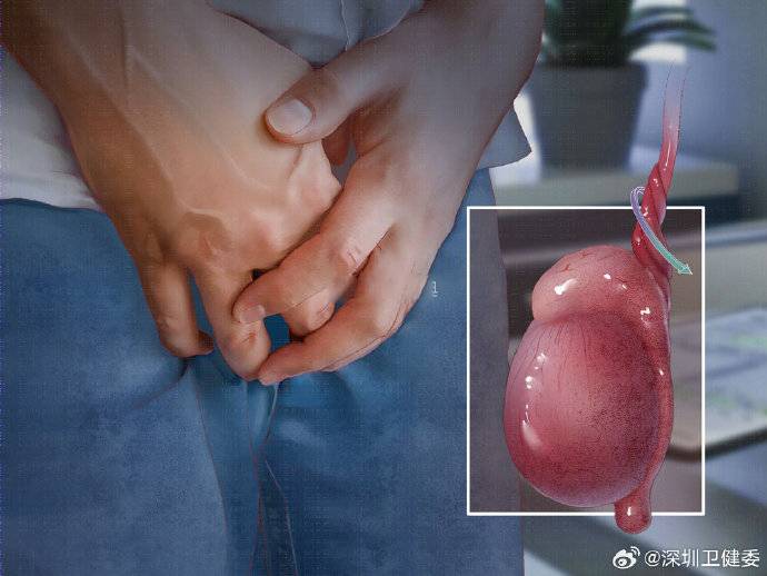 睪丸扭轉，是指懸吊睪丸的精索扭轉，會令睪丸的血液供應截斷，引致突發性的疼痛和腫脹。   深圳衛健委