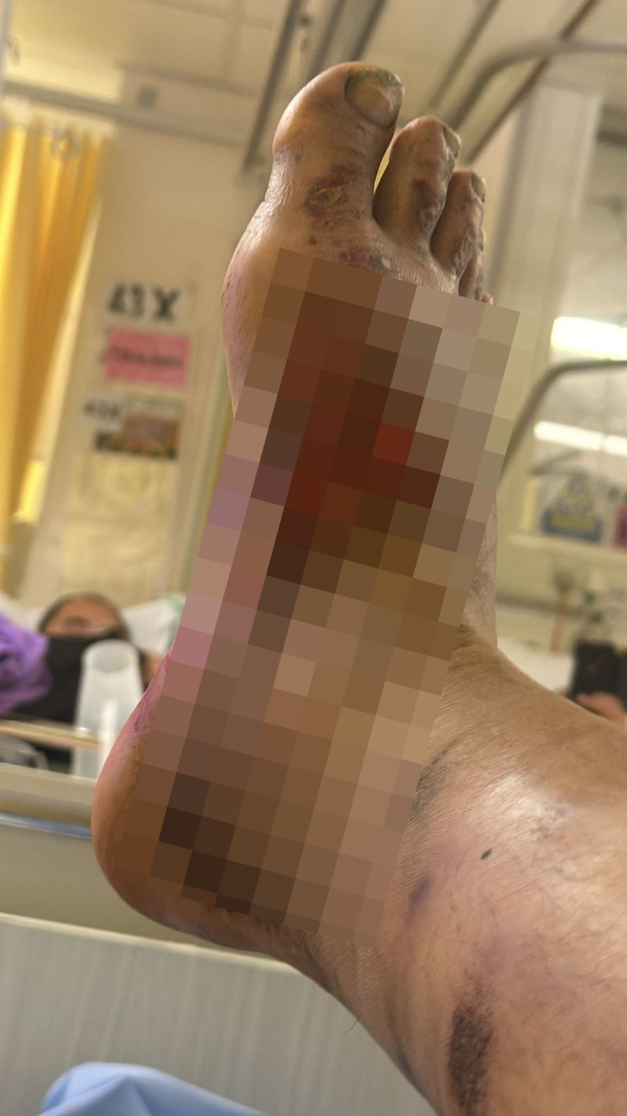 去年文禮「落石屎」期間,被灼熱混凝土灼傷腿部,但最後被迫隱瞞。受訪者提供 去年文禮「落石屎」期間,被灼熱混凝土灼傷腿部,但最後被迫隱瞞。受訪者提供