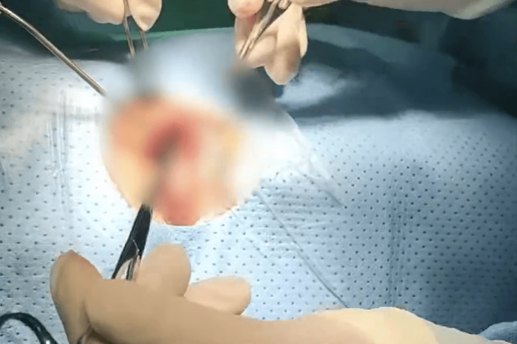 医生动手术将笔头取出。