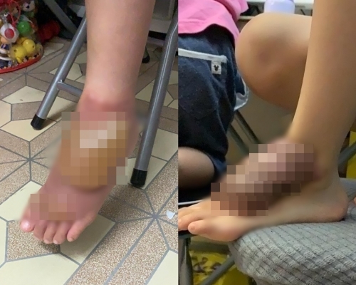 網民帖出家姐的兒子腳部淥傷的兩張相片。「公務員secrets」Facebook專頁相片