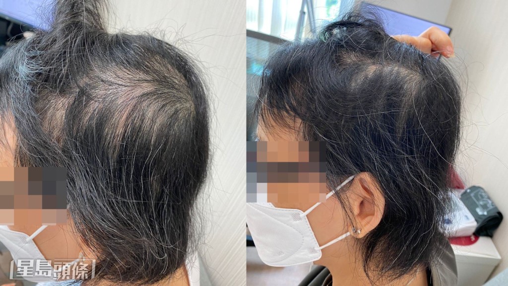 治療前後，該患者髮量明顯不同。李醫師指出，若對方沒積極治療，有機會變成「全禿」。（相片由註冊中醫師李灼梅提供）