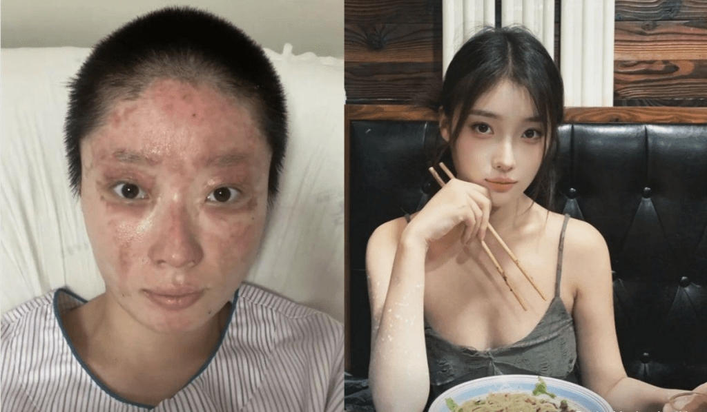 燒傷前後的童瑤。