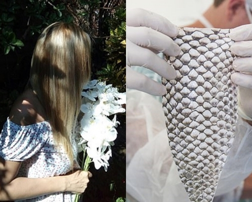 Maju接受手术，成为史上首个以「吴郭鱼皮」制造阴道的跨性别人士。 网上图片