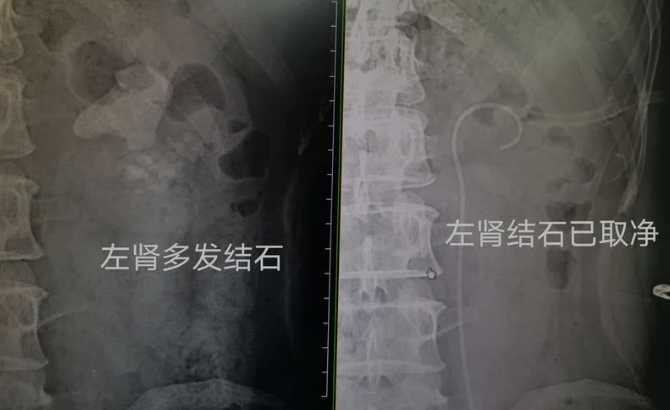 張男進行鏡碎石手術。網圖