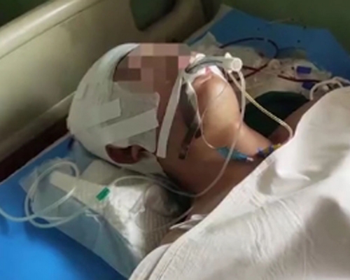 河北15歲男生遭毆打後腦出血。