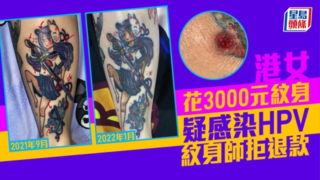 港女花3000元紋身疑感染HPV 紋身師拒退款  ​