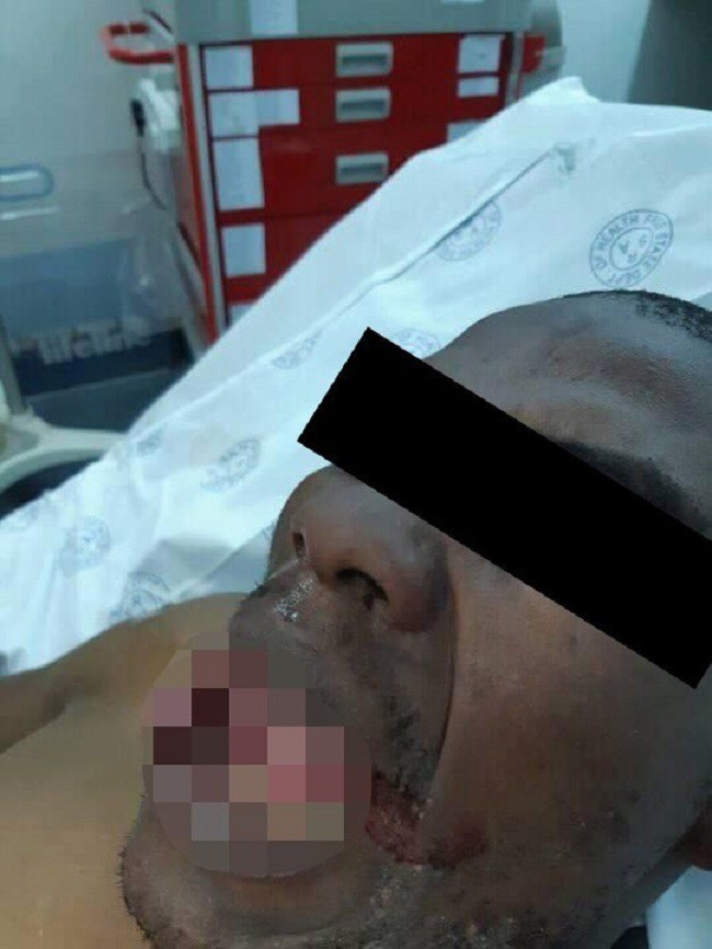 男子被咬斷舌頭。網圖