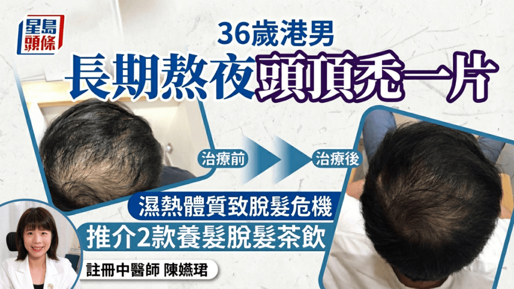 36岁港男长期熬夜头顶秃一片 湿热体质头发易出油致脱发危机 中医推介2款养发脱发茶饮