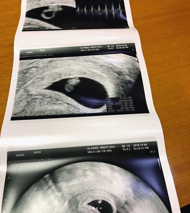 雅琳上載超聲波照。IG