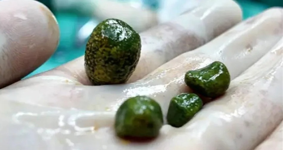 經微創手術順利取出 4 顆形似「綠松石」的罕見翠綠色結石。 經微創手術順利取出 4 顆形似「綠松石」的罕見翠綠色結石。