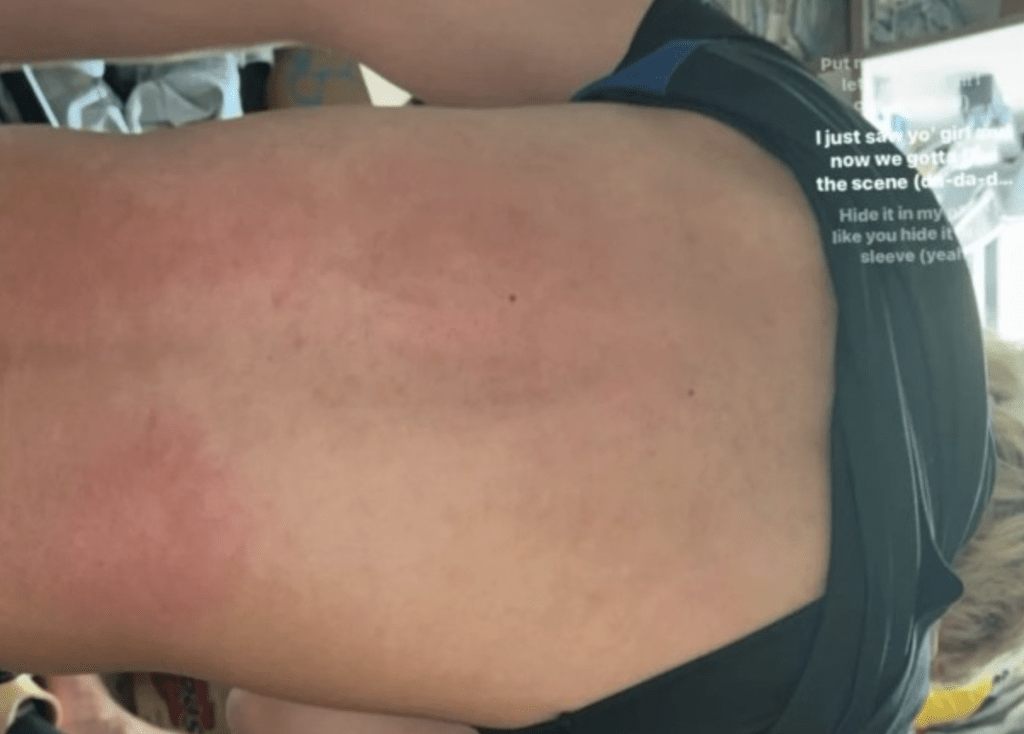 另一張相片則有一名男學生拉起上衣,背部留下大片紅印。 另一張相片則有一名男學生拉起上衣,背部留下大片紅印。