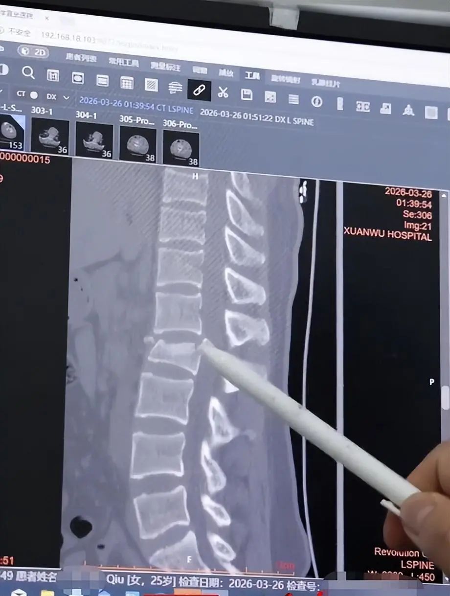 小秋事發後腰椎骨骼嚴重受損。紅星新聞