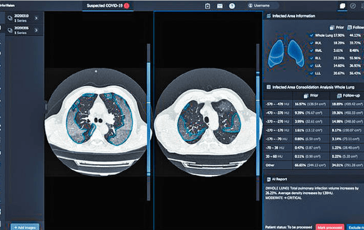 InferVision的肺炎电脑扫描比较受感染的肺部变化，并且数量化肺部的感染。