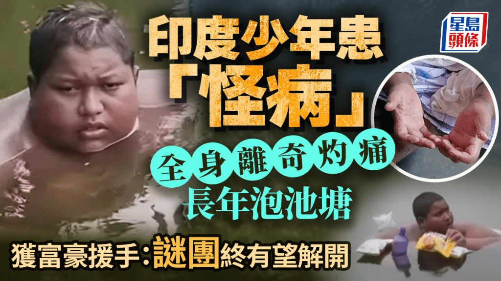 印度16歲男離奇全身灼痛長年泡池塘 影片瘋傳獲富豪援手 終有望揭開怪病之謎