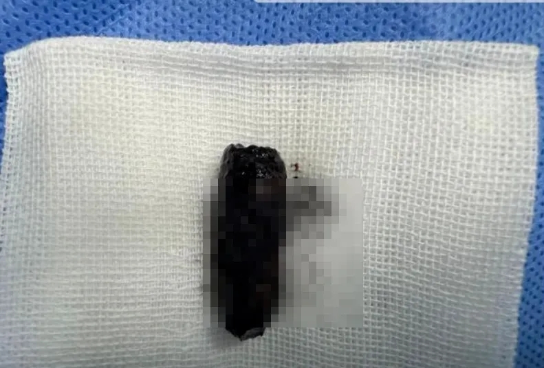 醫生取出「潛伏」40年的螺絲。