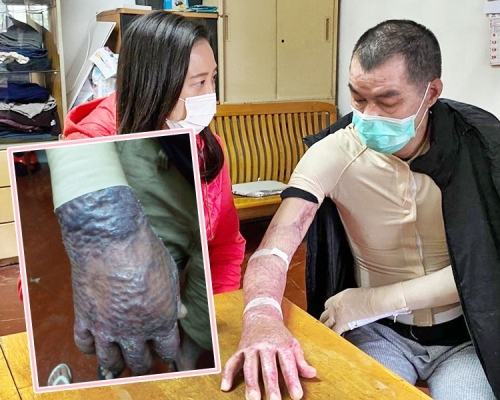 李先生的手臂不能伸直,植皮手臂腫起瘀黑。葛珮帆fb圖片