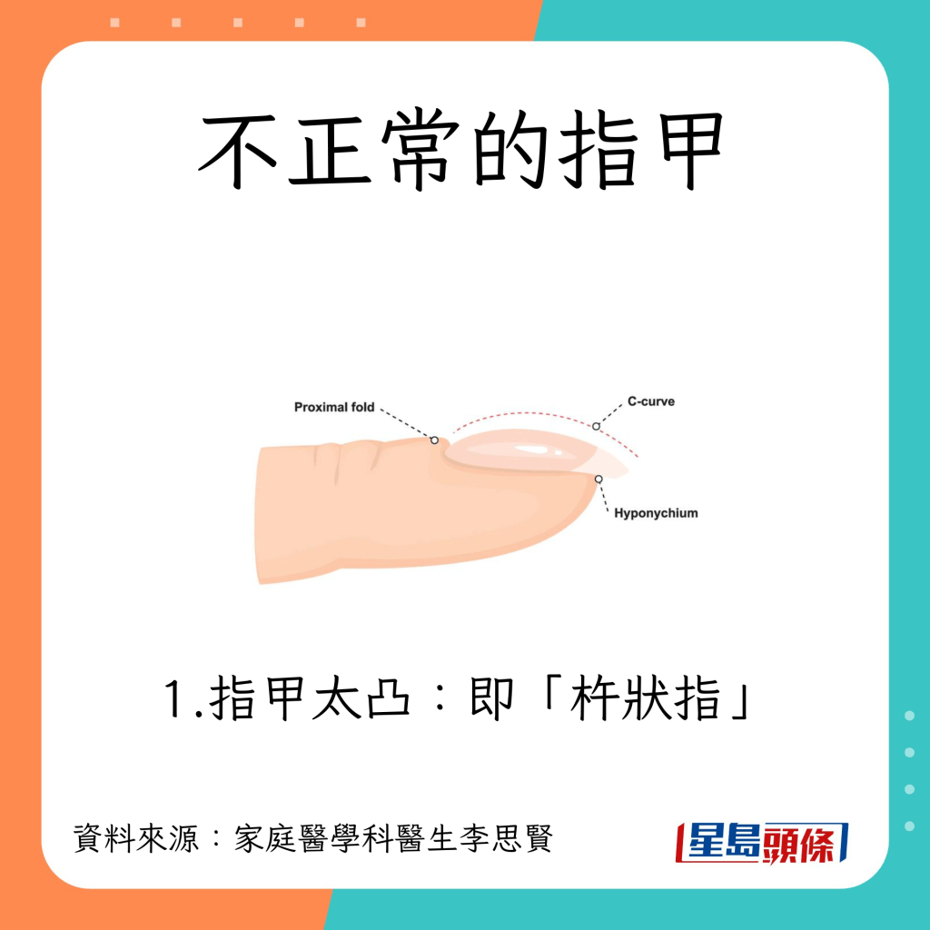 不正常指甲:杵狀指