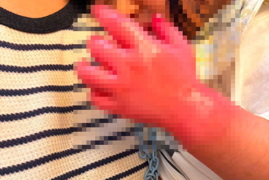 女嬰雙手二級燒傷。fb圖片 女嬰雙手二級燒傷。fb圖片