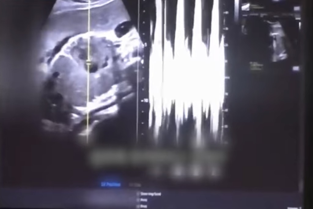 胎儿差不多已成形，也有心跳。 Youtube