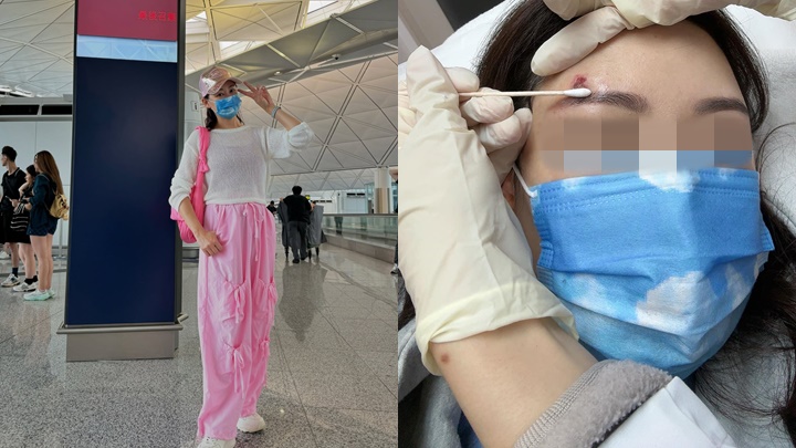 47歲視后胞姊兩度生蛇打蛇針現強烈反應 年初不慎細菌感染延遲診治致額頭疤痕